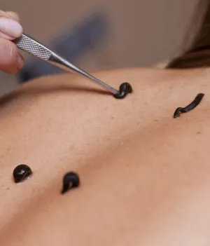 Leech Therapy in Jaipur