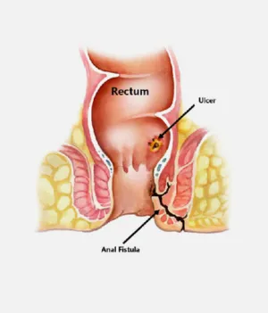 Piles Fissure & Fistula in Jaipur