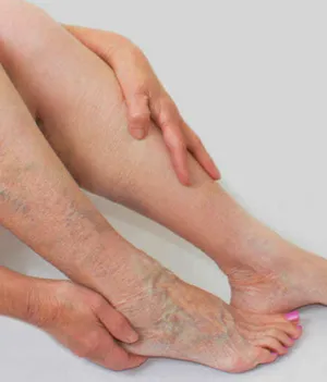 Varicose Vein Treatment in Jaipur