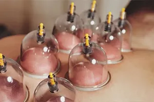 Cupping Therapist Course in Gujarat