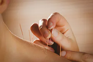 Acupuncture Course in Gujarat