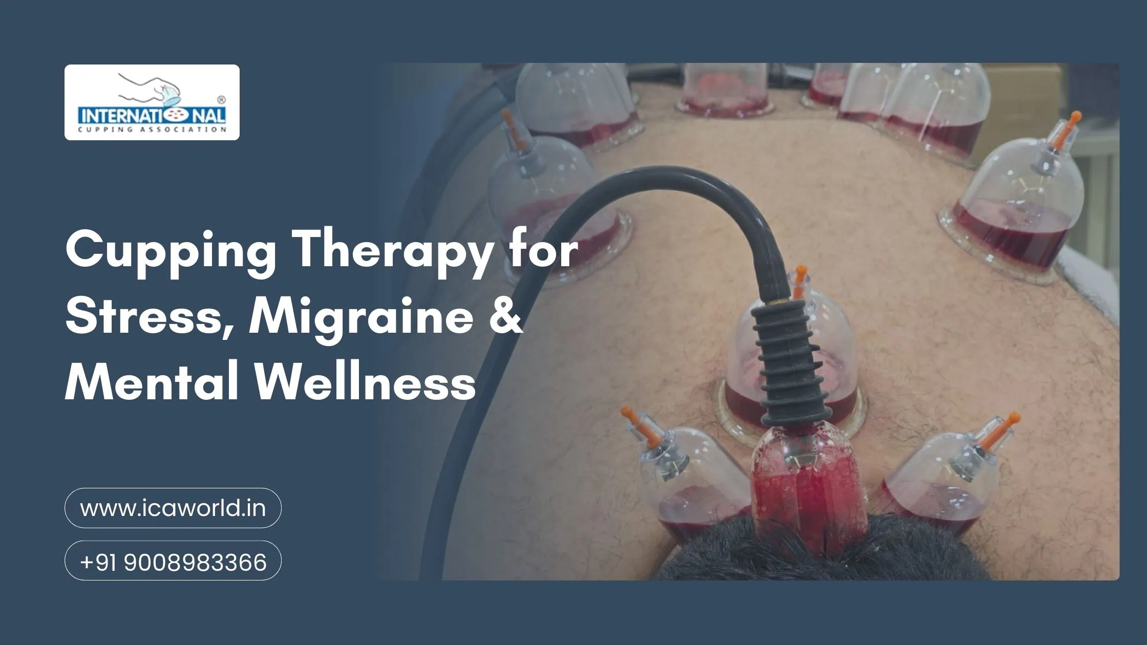 Cupping Therapy for Stress, Migraine & Mental Wellness