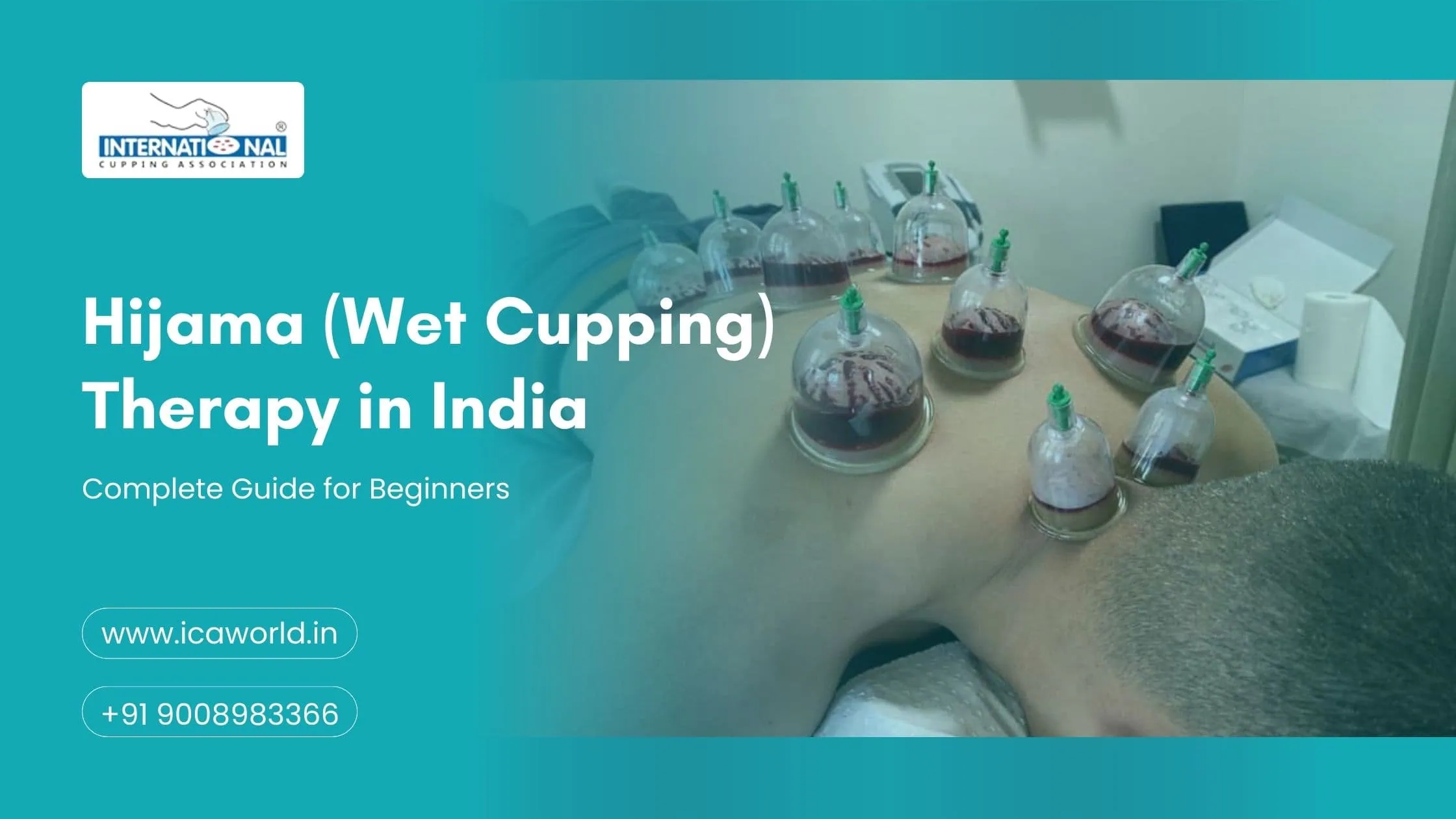Hijama (Wet Cupping) Therapy in India: Complete Guide for Beginners