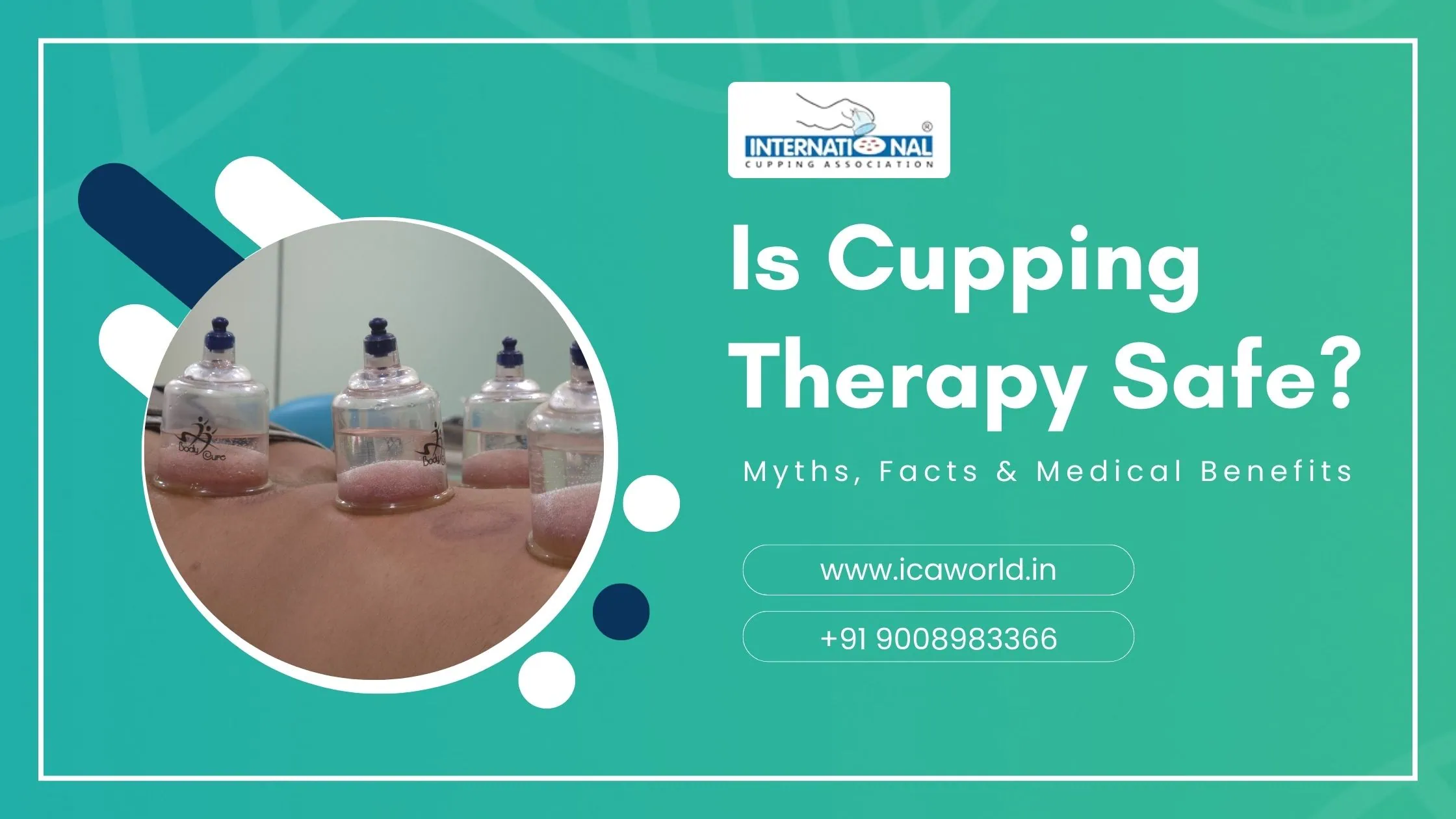 Is Cupping Therapy Safe? Myths, Facts & Medical Benefits